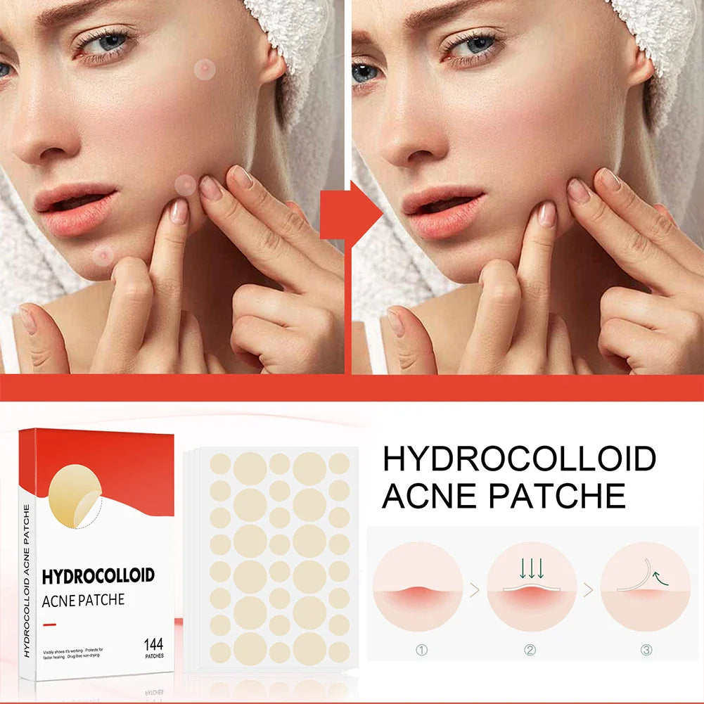 144-Piece Hydrocolloid Acne Pimple Patch Set – Invisible Absorbing Spot Stickers for Facial Blemish Protection and Healing Care for Men and Women